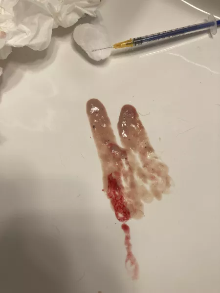 Aftermath of the abscess (first time poster/lurker status lol) by Zippiestrock