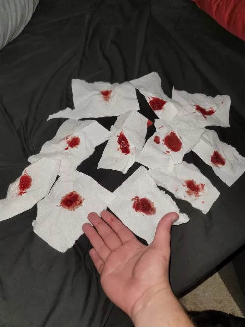 All the blood from a cyst on my ass. It popped a couple weeks ago too and the blood was running down my leg and dripping on the floor. I've never seen so much blood come out of me. Hand for scale by analscreams