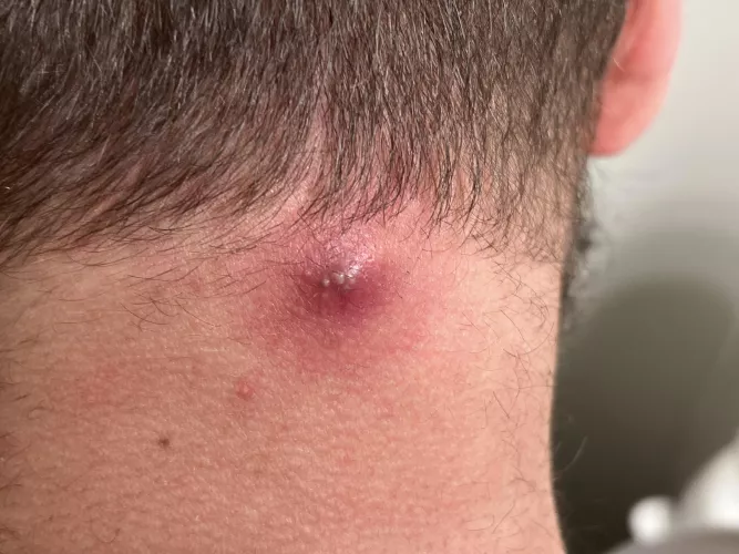 Angry boi on my neck from a year old cyst by flickerdown