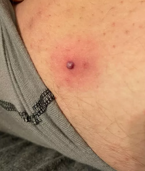 Angry boi on my thigh tonight by hankthepigeon570