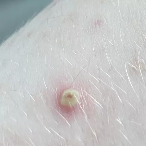 angry keratosis pilaris after popping a day before (sorry i don’t have a video, but you know it’s a good one when it’s yellow lol, had to share) by banana_fr0g