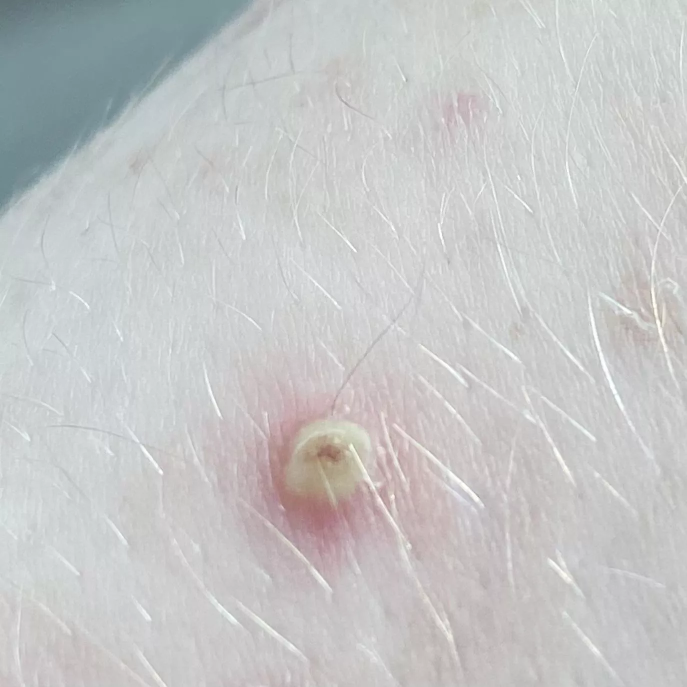 angry keratosis pilaris after popping a day before (sorry i don’t have a video, but you know it’s a good one when it’s yellow lol, had to share) posted by banana_fr0g
