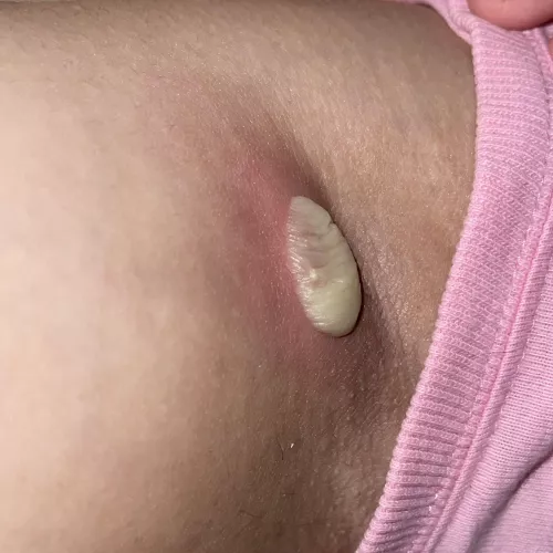 Anybody know what this is? It’s at the armpit area, maybe lymph node? It’s also swollen at the inner surrounding area by SeveralAd22