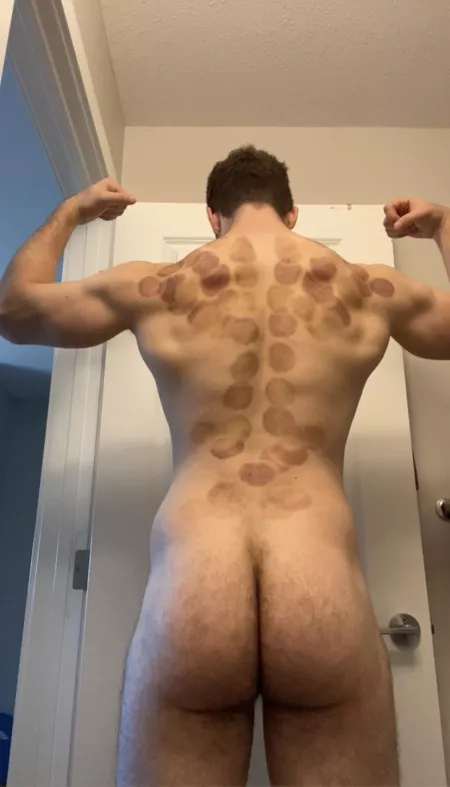 Anyone ever tried cupping? by Jackpackage71