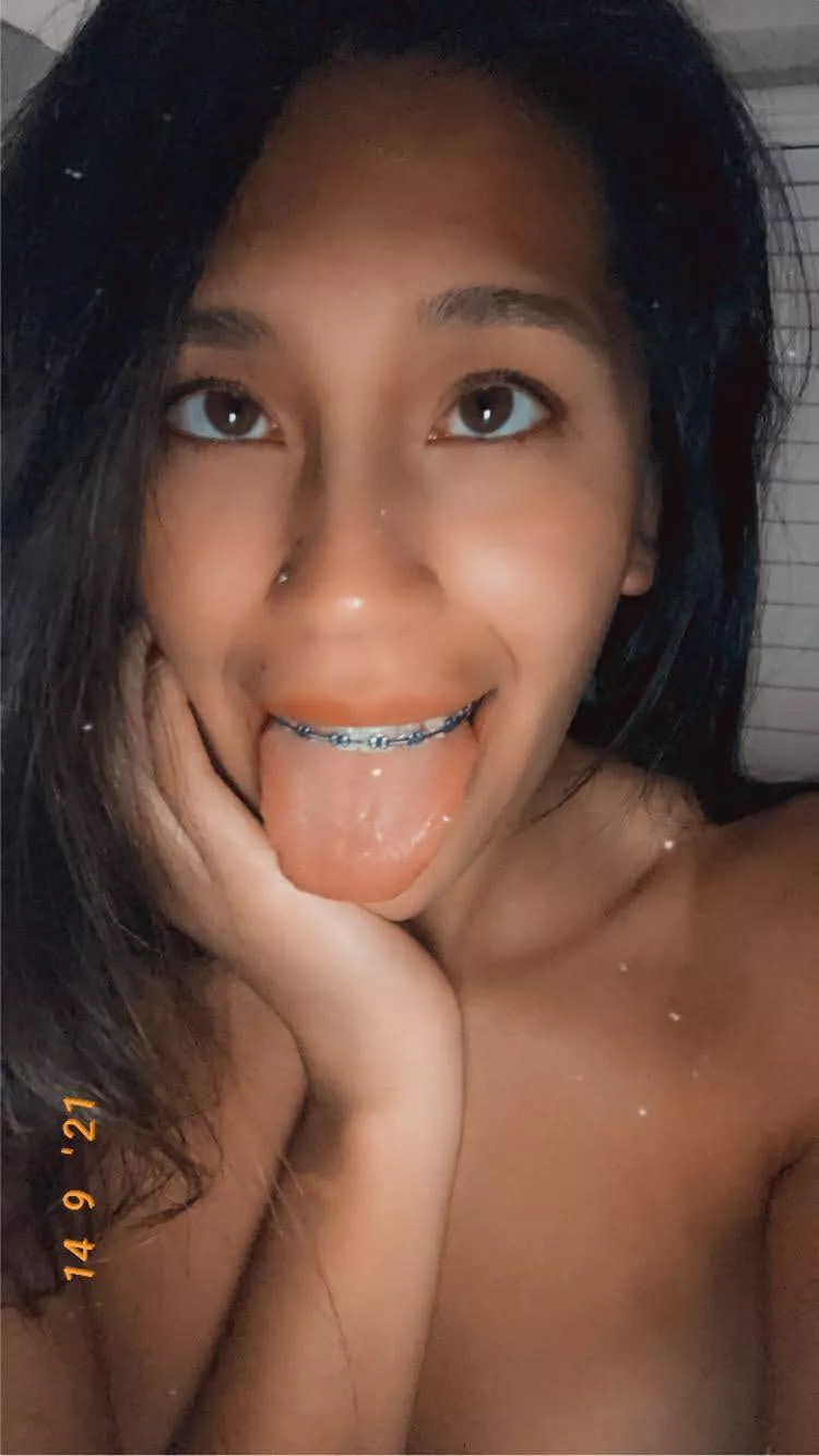 Anyone like braces?? posted by Free_Aerie_2611