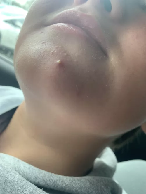 Becoming a teenager and he won’t let me pop it! by guitarman83