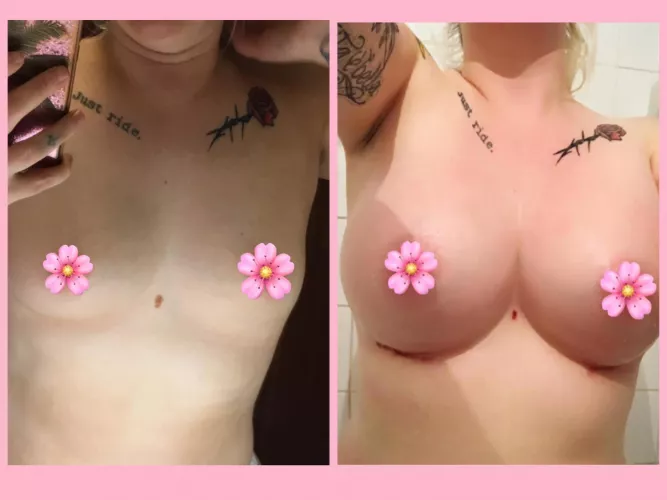 Before and 10 days psot op by undertakerroyal