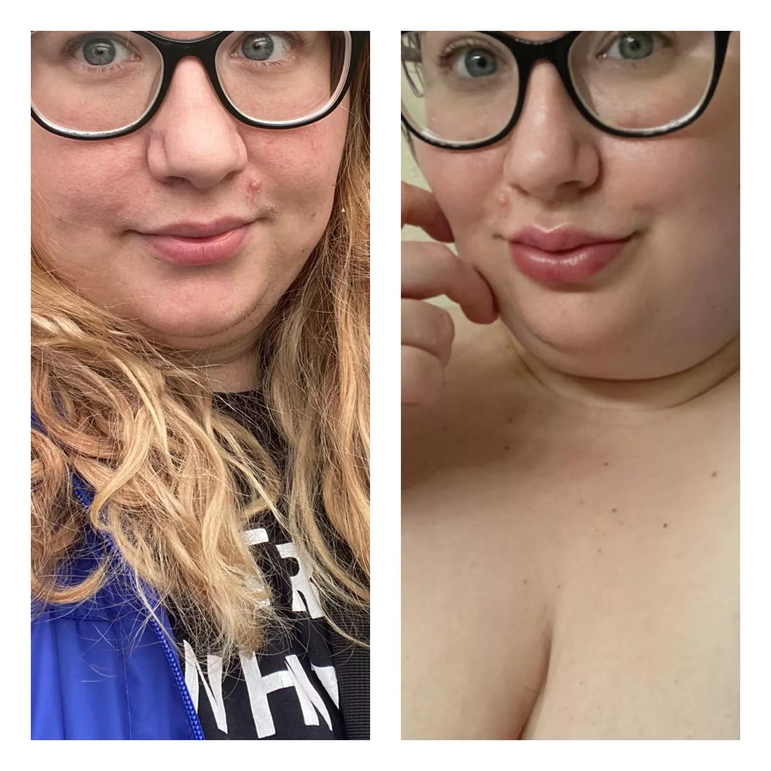 Before and after. First ever lip filler done the other day. I want more posted by mollyisatease