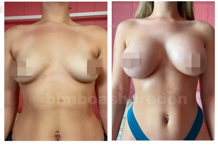 Before/After Boob Job (My Pic, Watermark is Twitter Username!) by slutmeup