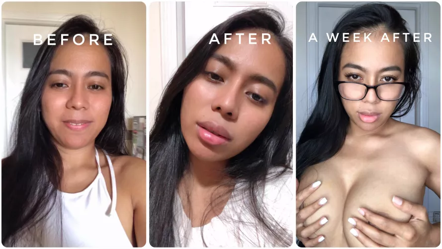Bimbo journey update: A generous supporter funded my first ever round of lip fillers! I’m sooo over the moon!! 😍🥰💕How do I look? ;) by AsiaMorena