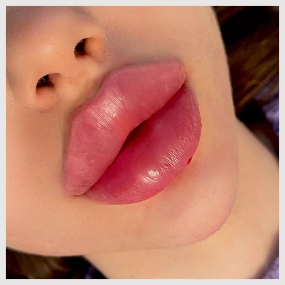 Bimbo lips fresh from injection posted by proutlabulle