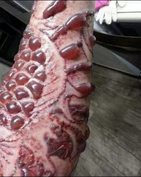 Blisters following laser treatment to remove tattoos. Not me, found in FB tattoo group. by Gus_Jensen