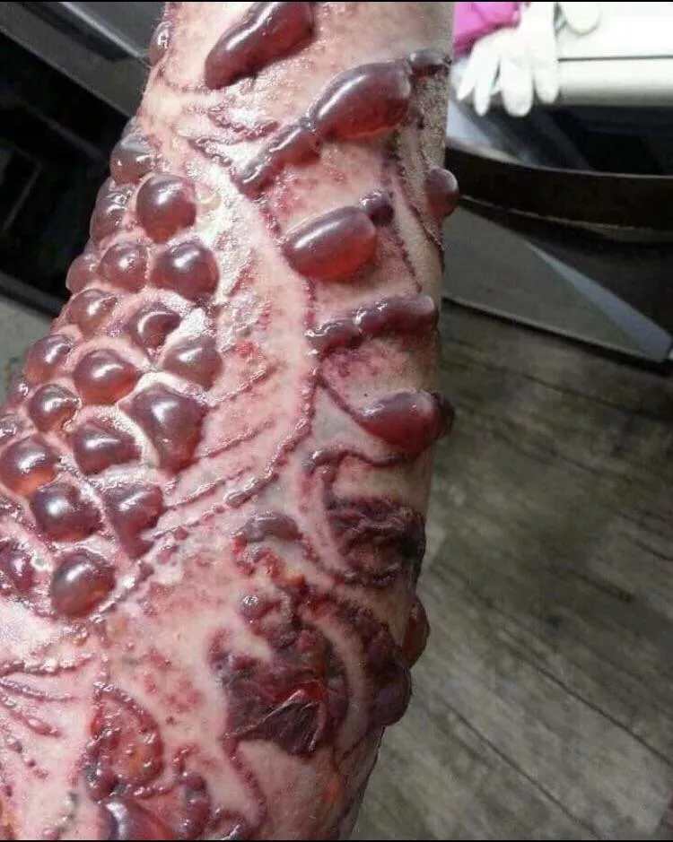 Blisters following laser treatment to remove tattoos. Not me, found in FB tattoo group. posted by Gus_Jensen