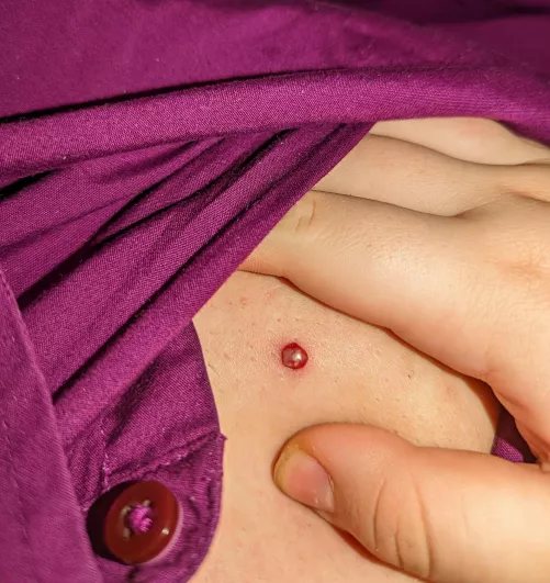 Bloody twat popped while I was adjusting my camera to record; stained my favorite button up with blood. Still wanted to share this dickface of a zit by bucketoftwinks