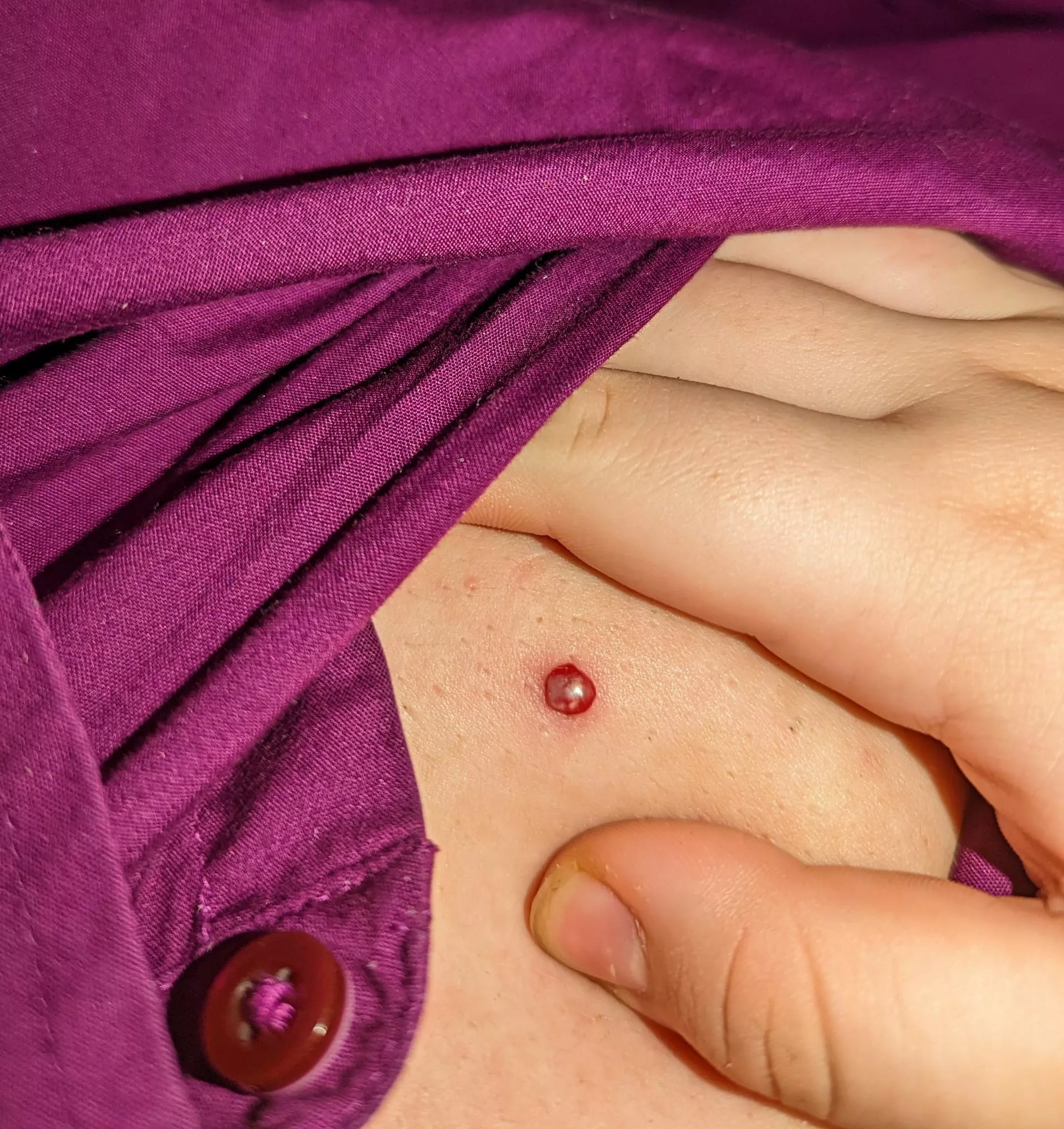 Bloody twat popped while I was adjusting my camera to record; stained my favorite button up with blood. Still wanted to share this dickface of a zit posted by bucketoftwinks