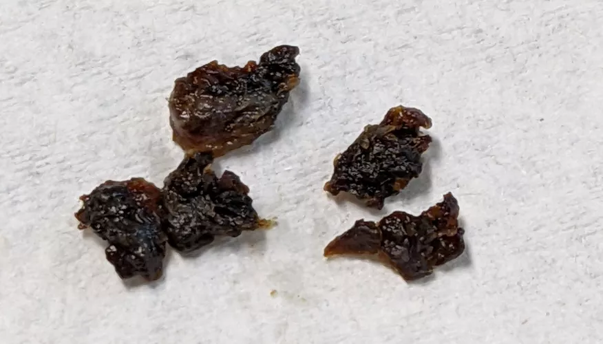 Both ears were full of wax, went to a specialist to get them cleaned out. This was all from the ear with the least severe blockage. by froderick