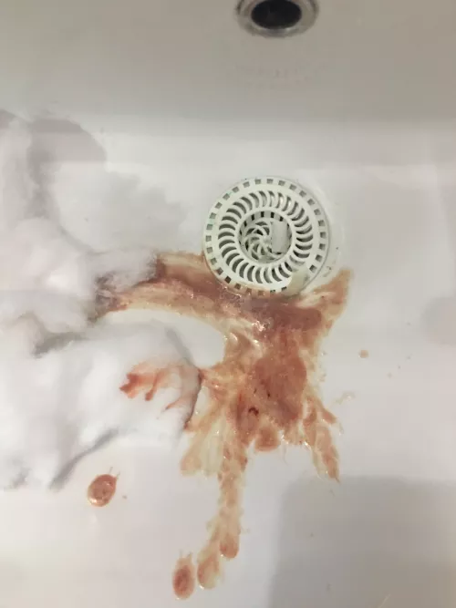 breast cyst erupted,less pus than last time,but the stench was again deadly... by targonianstoryteller