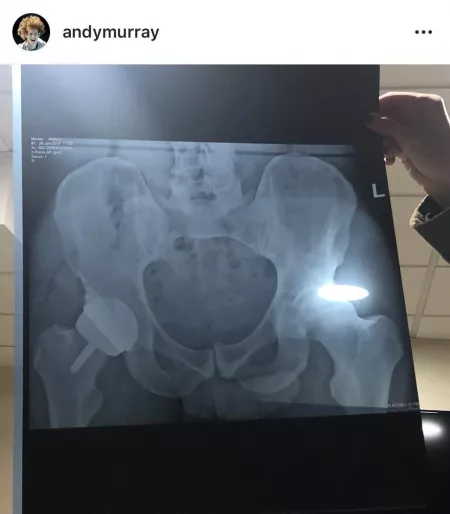 British/Scottish tennis player Andy Murray posted his hip X-ray to Instagram a while back. Little Andy is showing up 😂 by jordan-jay