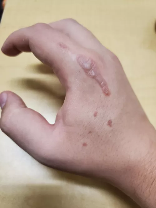 Burned my hand cooking our anniversary dinner. by petrifythepatriarchy