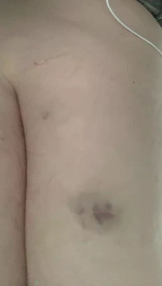 Cane mark posted by UniversityOk8652