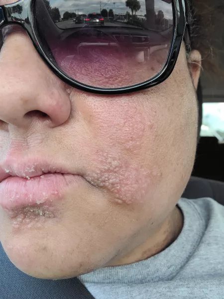 Changing seasons, stress, autoimmune response. I hurt! by crochetlistner