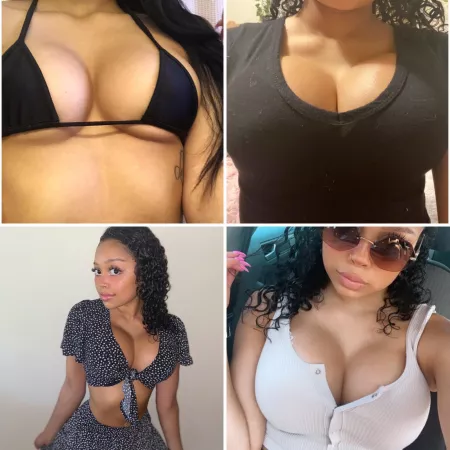 Coming up on my 3 month post-op appointment in a few days! Will be celebrating by getting fillers for the first time on the same day! by xojustbri