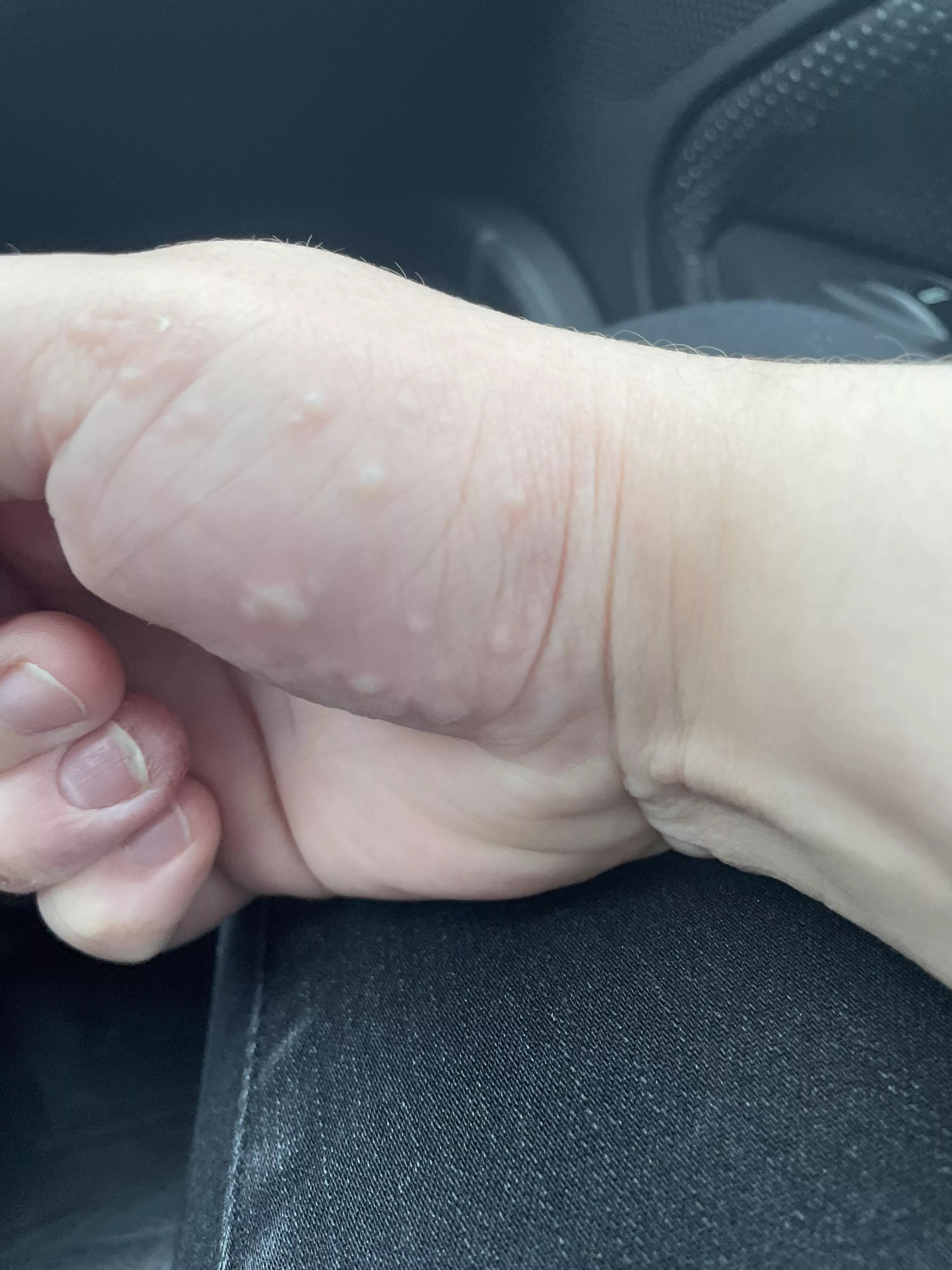 Contact dermatitis on my hand posted by sweaty_sanchez