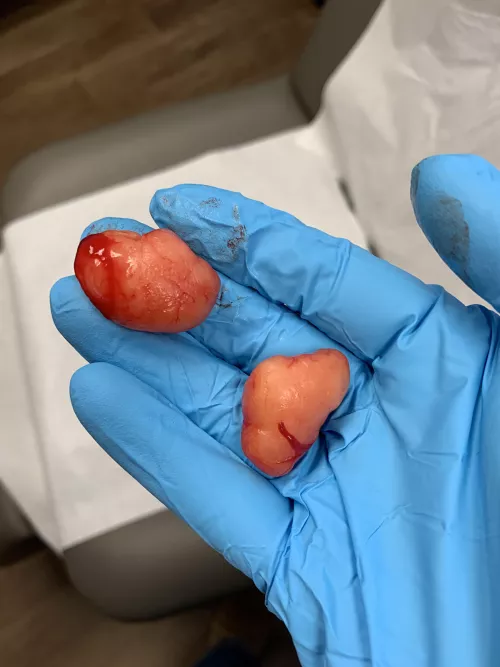 Couple lipomas from my chest by smokinporkbutts