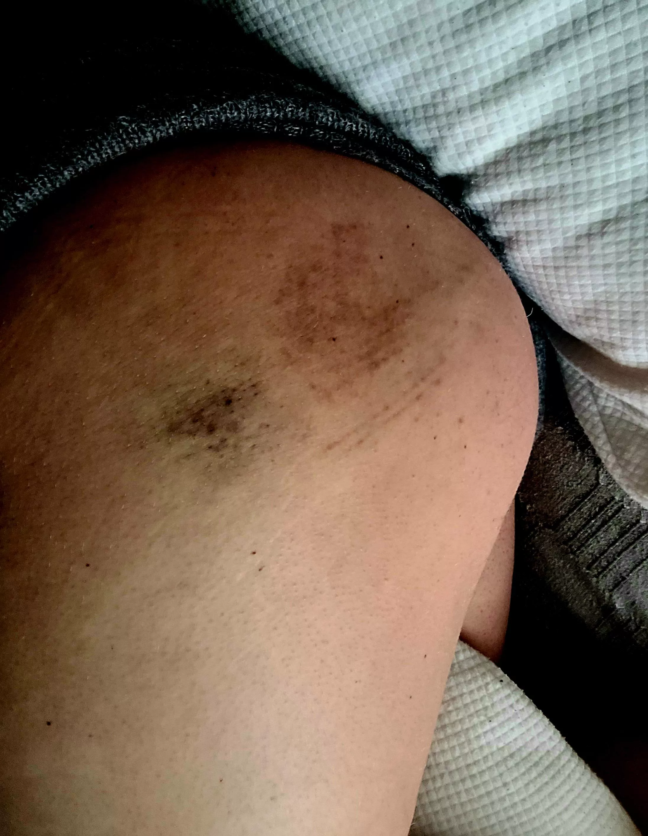 Day 3 of bruising 😈✨ the other butt cheek got at good round of spanking today posted by frkmbuh