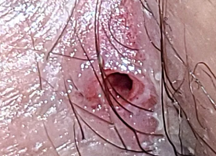 Decade old pilonidal cyst ruptured in my sleep... by DNthecorner
