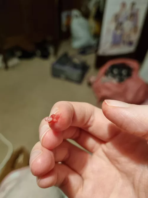 Deep verruca root I just pulled out my foot. More info in the comments by piinkksnow