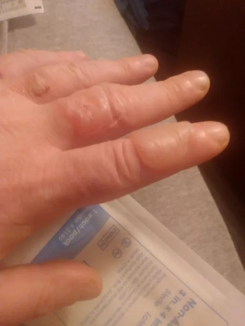 Do hot oil burn blisters belong here? Both fingers already drained. Index is ready for round 2. by MakingPlansForSmeagl