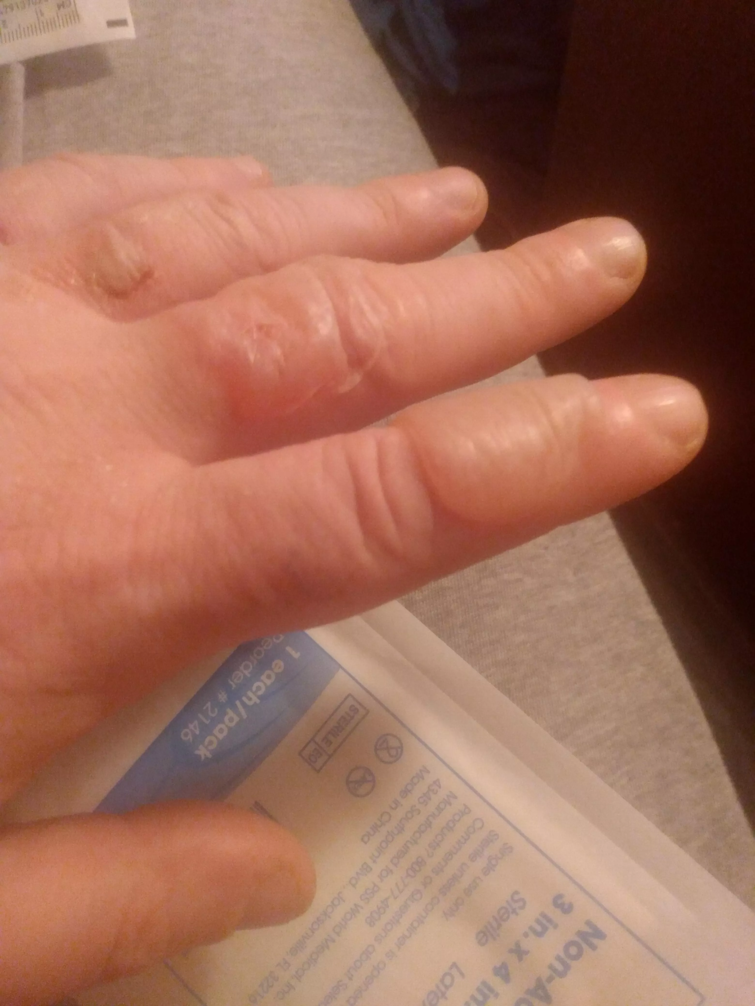 Do hot oil burn blisters belong here? Both fingers already drained. Index is ready for round 2. posted by MakingPlansForSmeagl