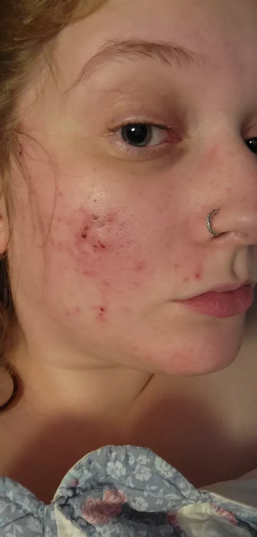 doctor-forbidden pops. all the pink underneath is scarring from me popping. Pop with caution, friends by chatonsnoirs