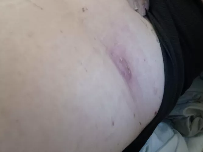 Double headed boil on my back, went to urgent care as it was super angery/ infected and earliest appointment with my derm was February. They lacerated it and drained it. 2 weeks of 2 antibiotics only to realize they didn't even take out the sack. Guess  by damndolly