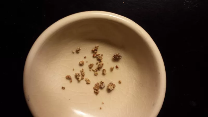 Dozens of painful kidney stones by not2dv8