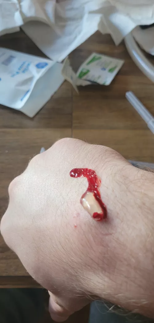 Drained the ganglion cyst on my wrist. Nobody could stomach filming it so here's the aftermath by n0st3p0nSn3k