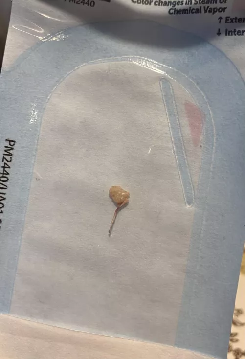 Endolith from tooth #3 root canal by Sarahtonin260