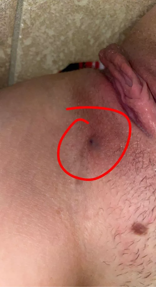 f19 5’5 120lb does anybody know what this is? i’ve been tested and i know im clean but this bump hurts and just won’t go away :/ by skinandbonesss