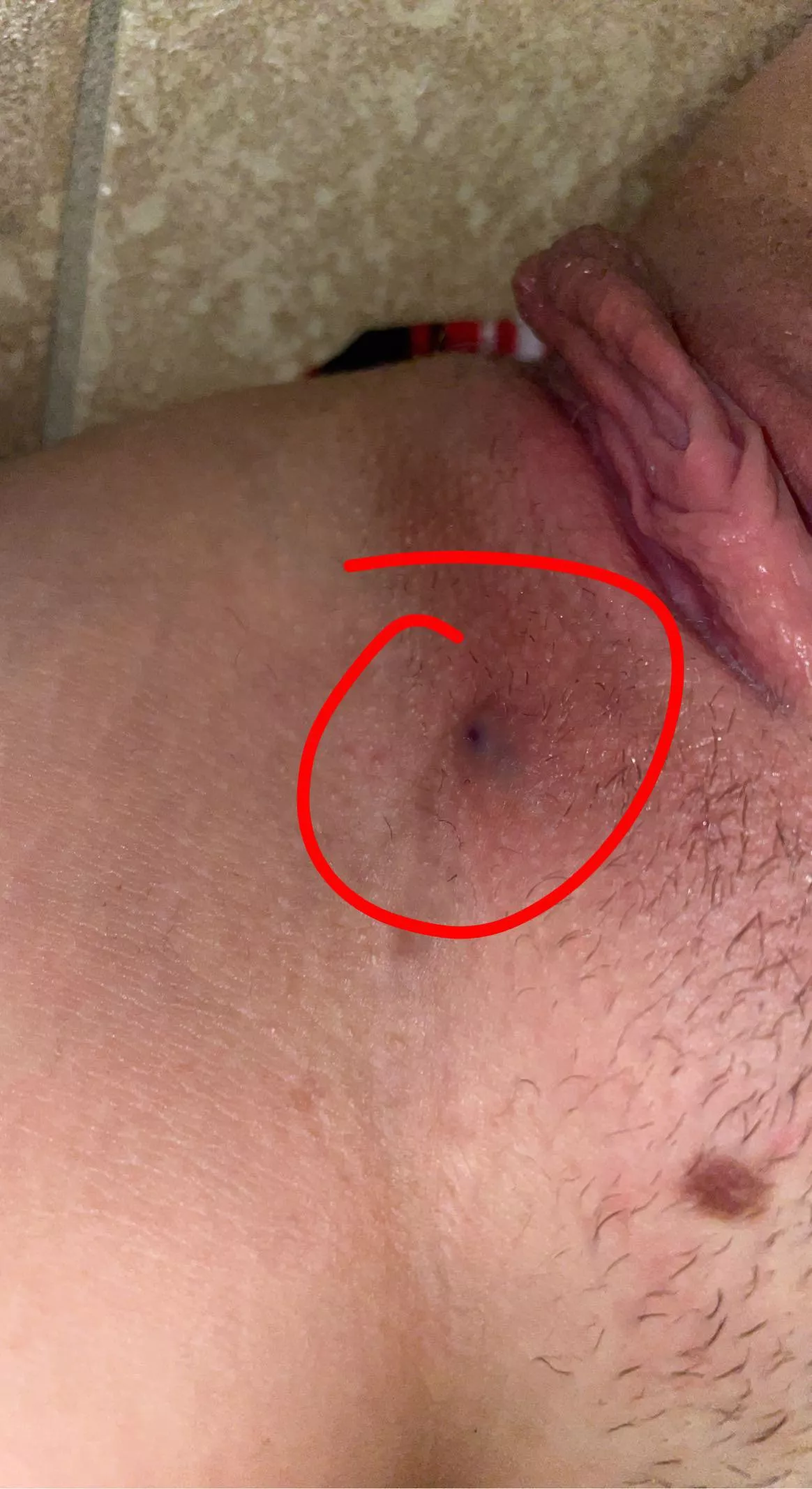 f19 5’5 120lb does anybody know what this is? i’ve been tested and i know im clean but this bump hurts and just won’t go away :/ posted by skinandbonesss