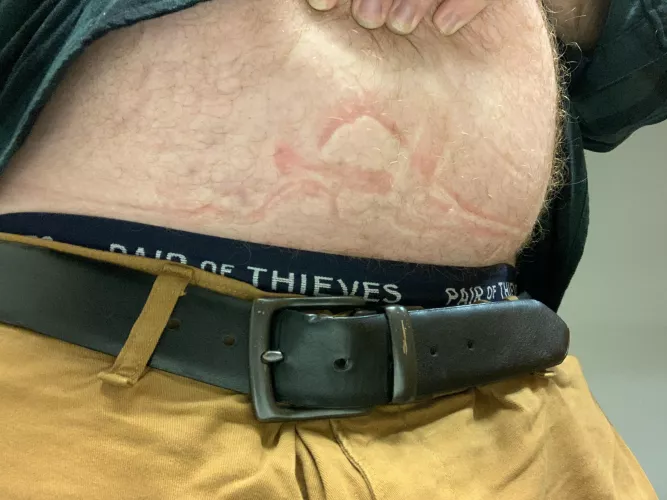 Fat guy problems by bigred1bear