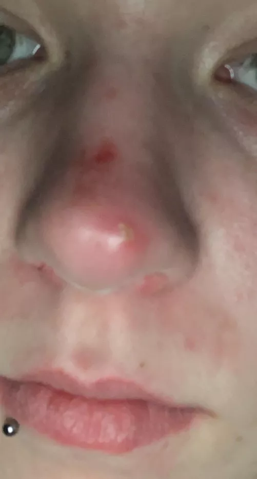 First post: had a giant red spot on the end of my nose for a week or so and while at work it started hurt whenever my mask rubbed it and then I see this beauty by Deadlove1415