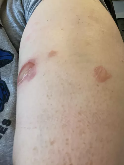 (First post/OC) Forbidden pops! Burns from boiling water, just removed the dressings by dudehawkeye