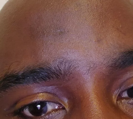 Followup to earlier post. Healing progress by Hippyfunk77