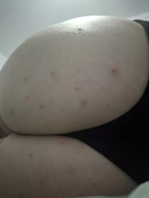 For some reason I keep getting butt pimples. NSFW because butt. by Micklebumbie