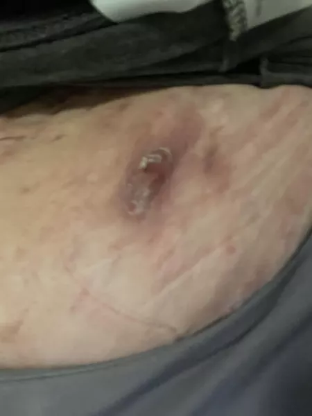 For y’all asking to see the aftermath of my bloody fingers the other day, here ya go. HS (hidradenitis suppurativa) is MISERABLE y’all.😫 by abrookehack