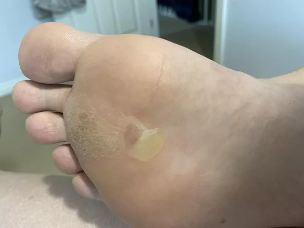 Forbidden pop - blister on a blister on my foot. Sucker hurts like hell! by hereforthefreeshiz
