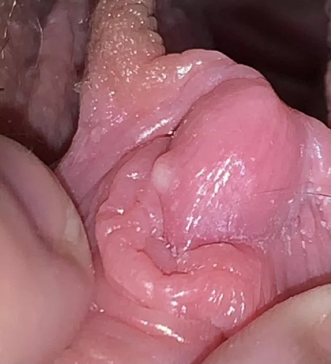 forbidden pop: went to the doctor and had this little lump checked out; turns out i have a tiny cyst ON MY JUNK. i’m thrilled! posted by tealanura