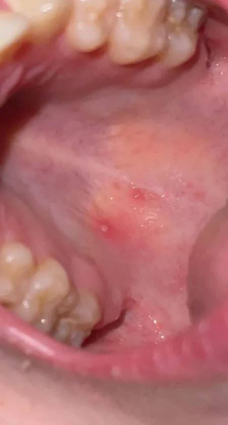 Forbidden pops in my mouth. Oral herpes flaring up by legolasisamanwhore