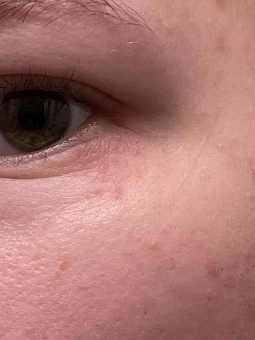 Forbidden pops under my left eye. Any idea what these are? They’ve been here for weeks. by legolasisamanwhore
